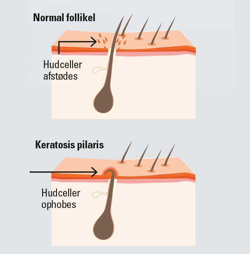 Grafik af hudoverfladen