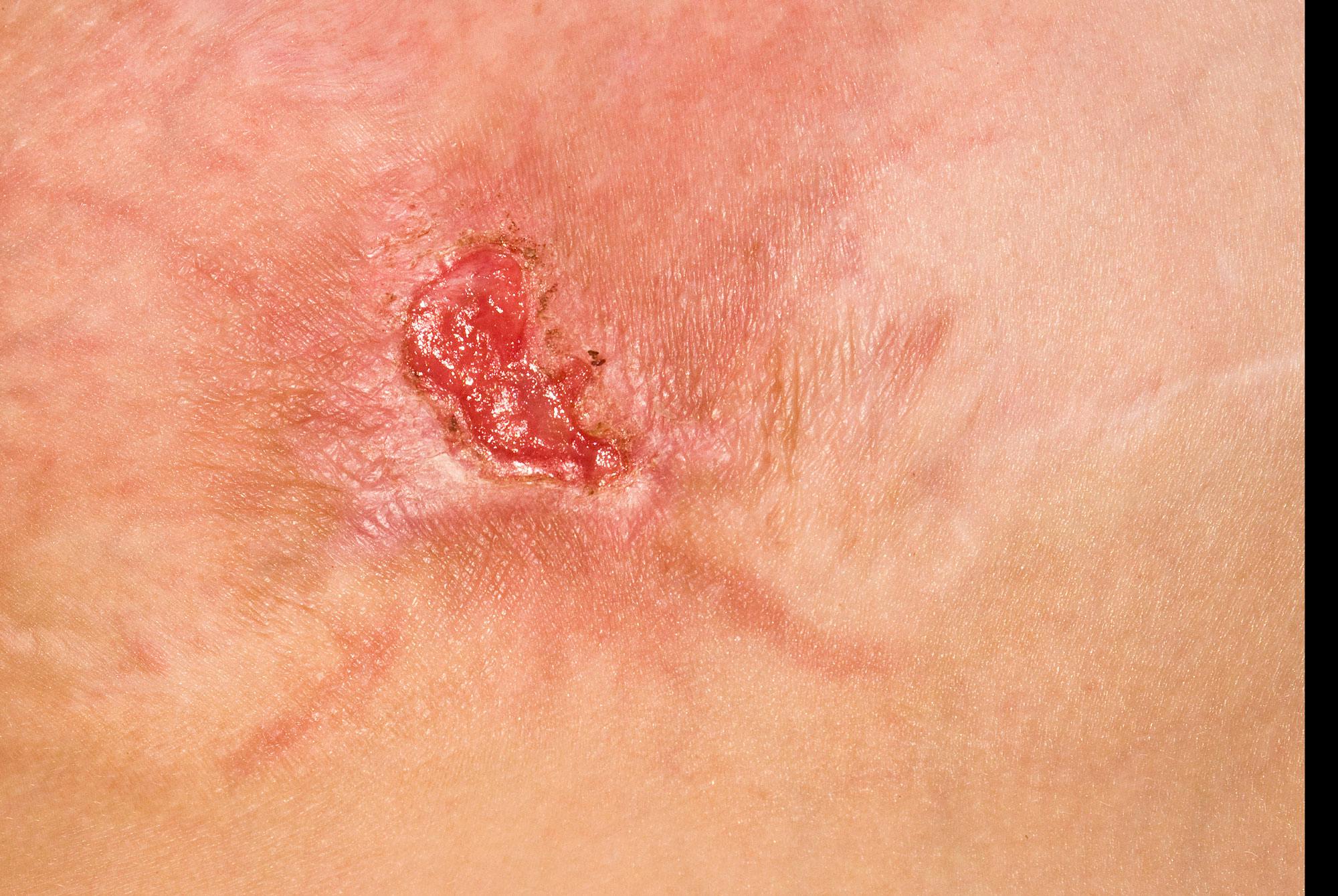 MRSA, resistente stafylokokker i sår