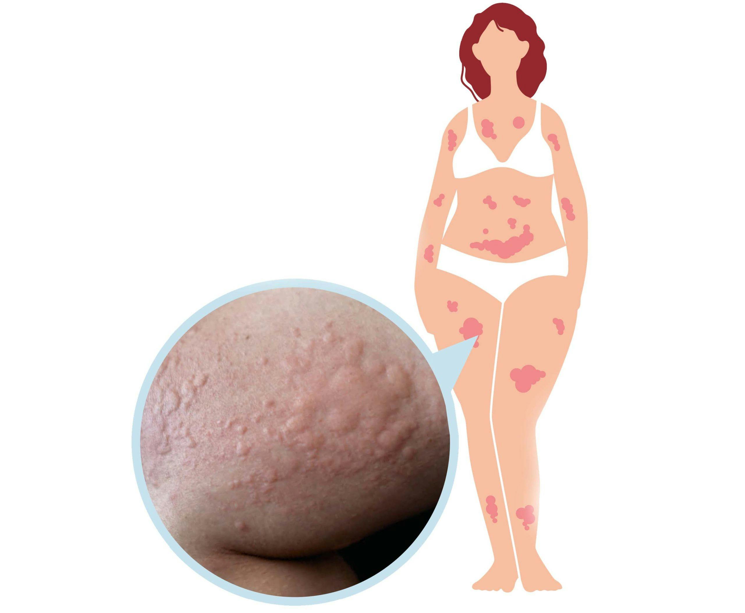 Nnokkosrokkoihottuma näyttää tällaiselta