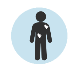 Autoimmuunireaktiona nokkosrokko