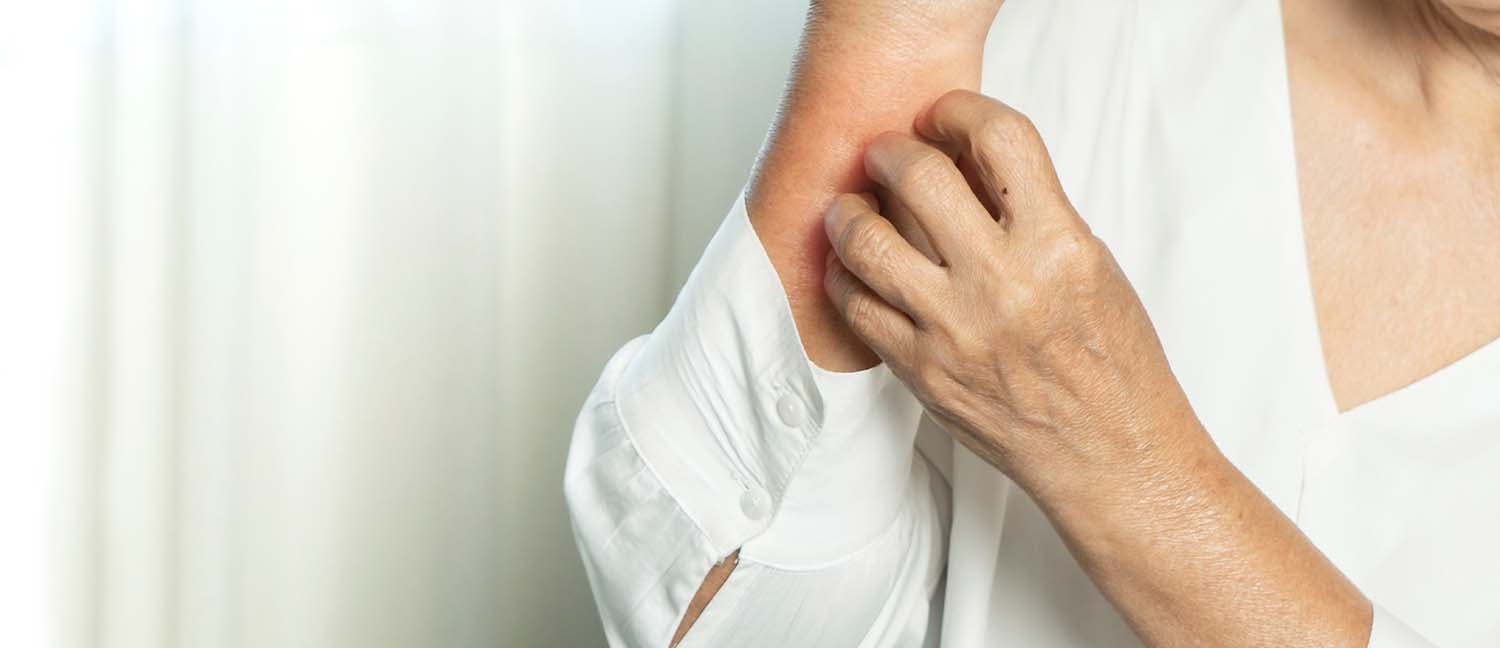 Nokkosrokkoihottuma käsivarressa kutiaa ja nainen raapii ihoaan