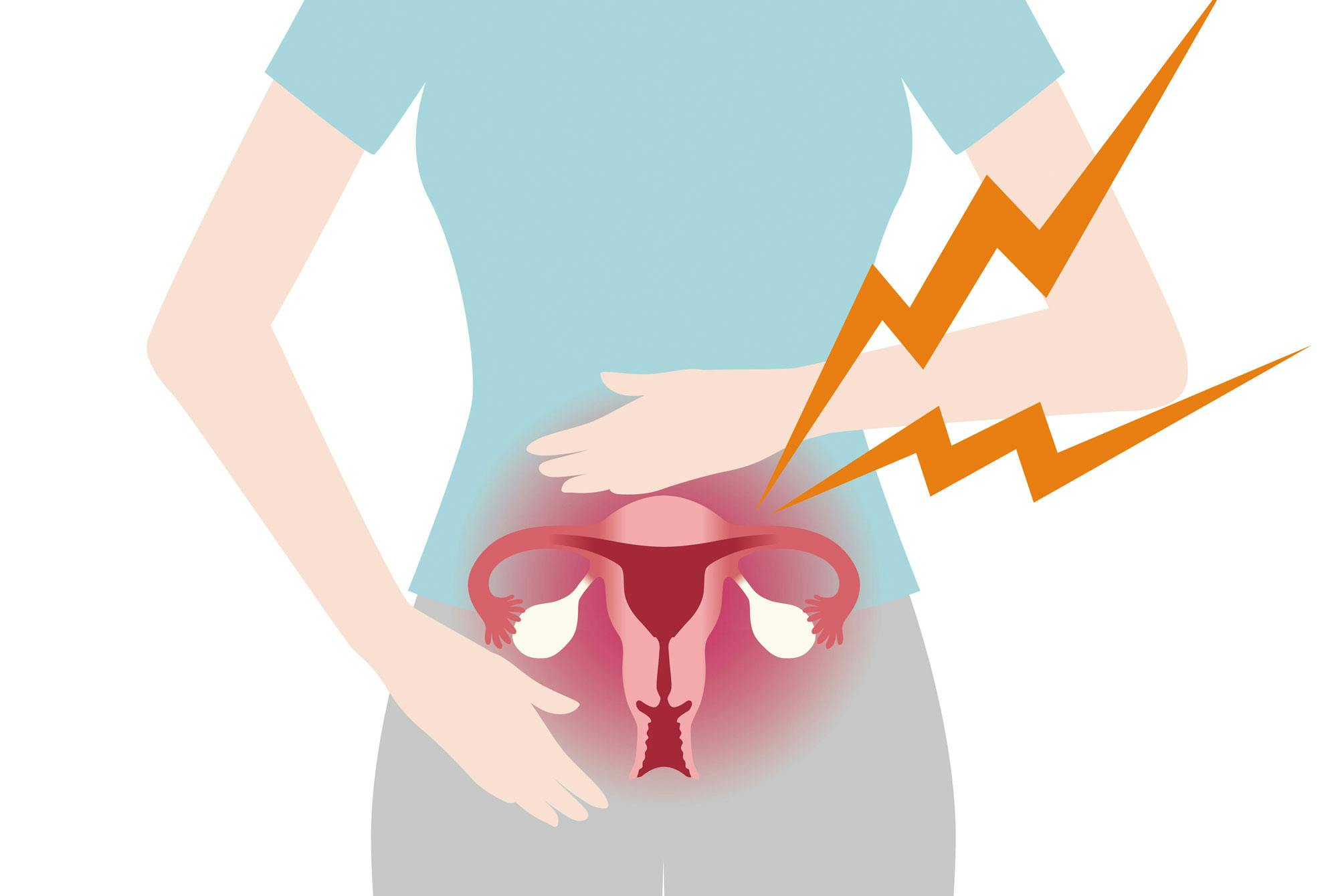 Nainen pitelee alavatsaansa endometrioosikipujen vuoksi