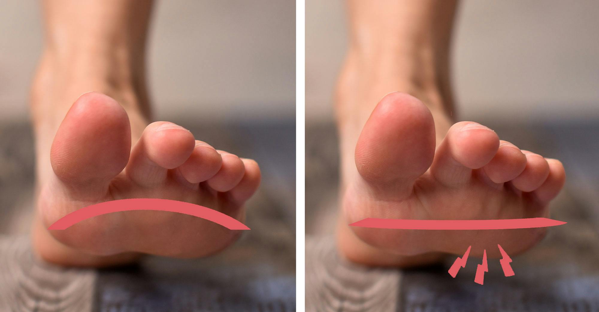 Normaali jalka ja etulattajalka