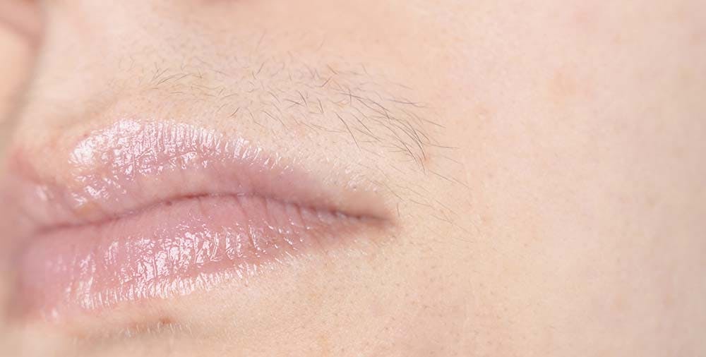 Kvinde med uønsket hårvækst på overlæben
