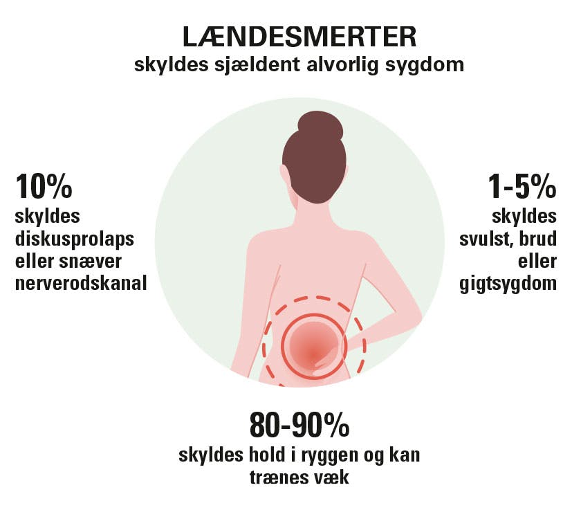 Fordeling af årsager til ondt i lænderyggen