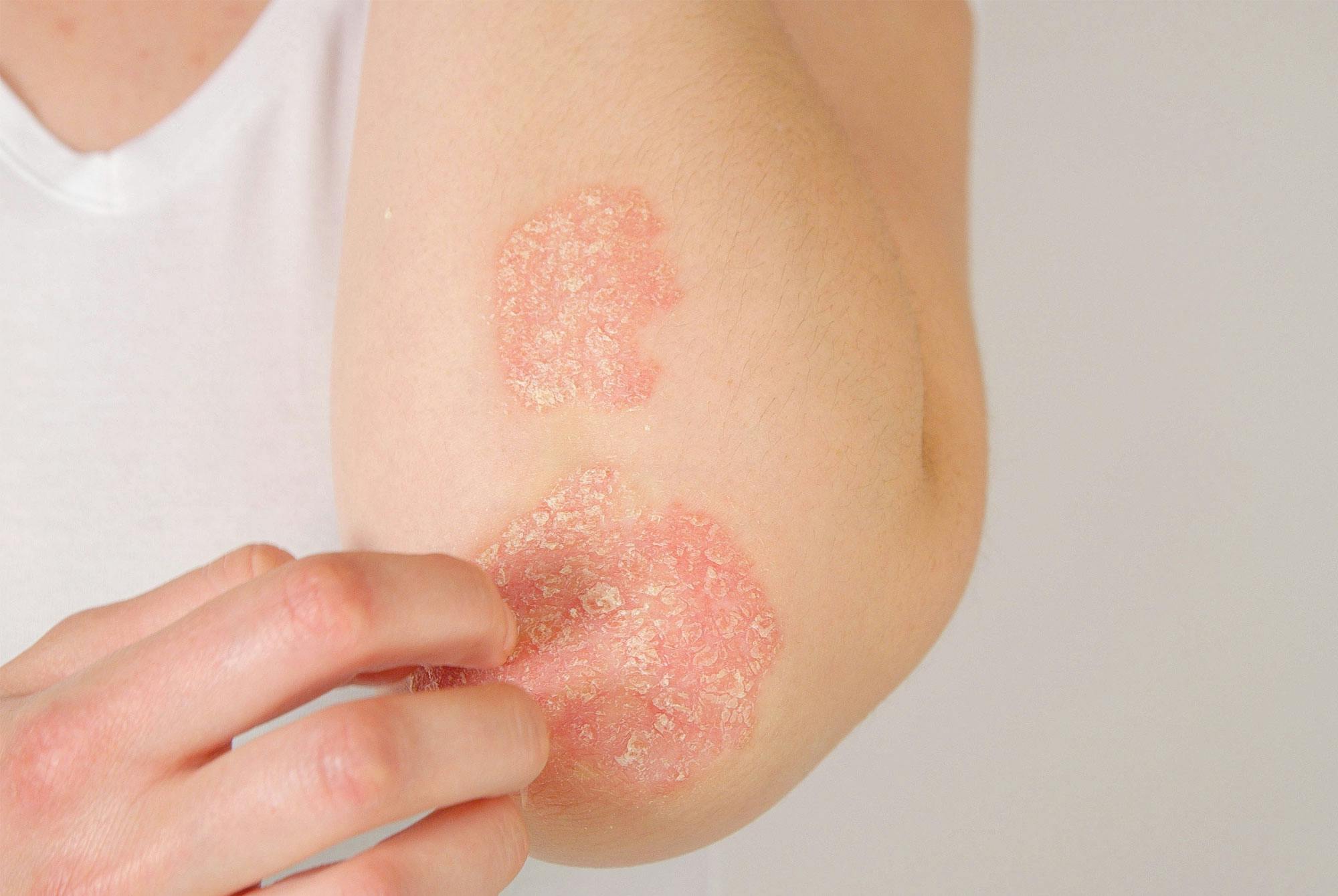 Kvinna med psoriasis på armen