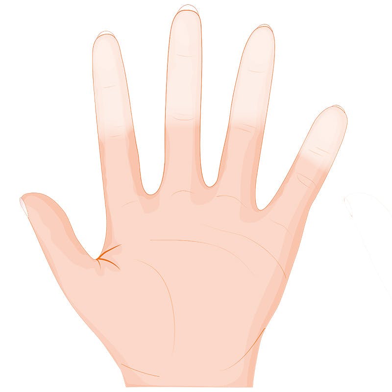 Grafiikka Raynaud’n ilmiö vaihe 1