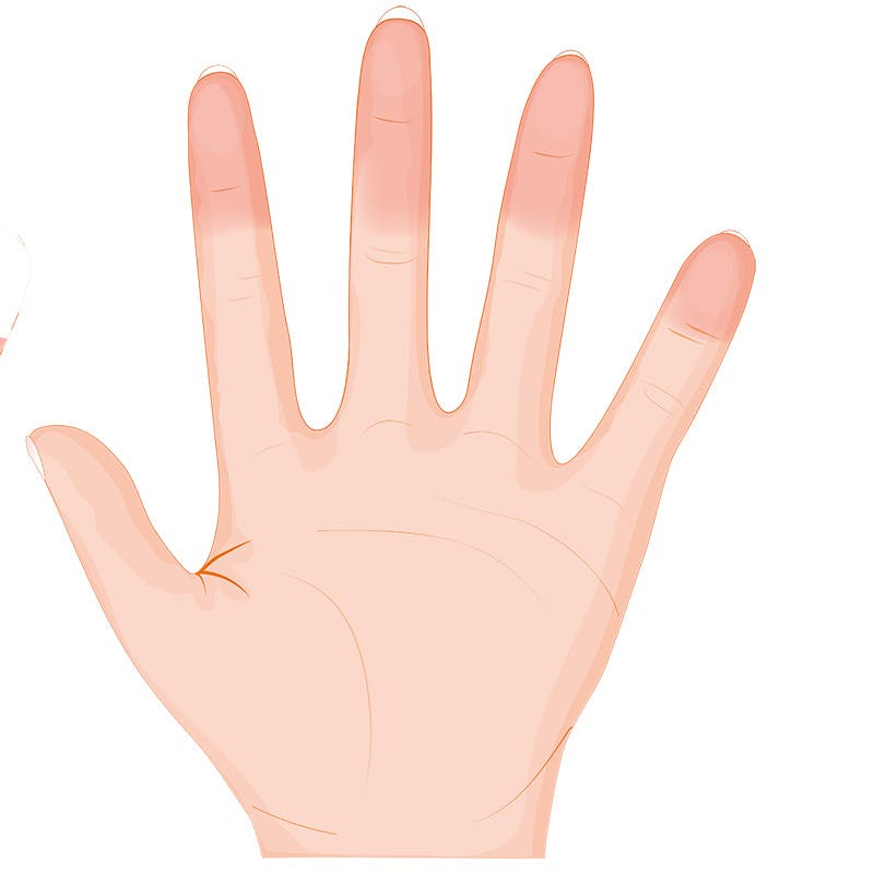 Grafiikka raynaud’n ilmiö