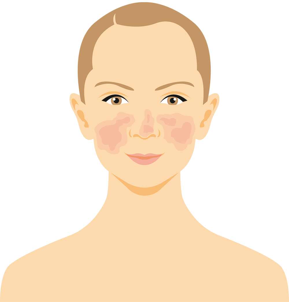 Sådan udvikler man hudsygdommen - fase 1