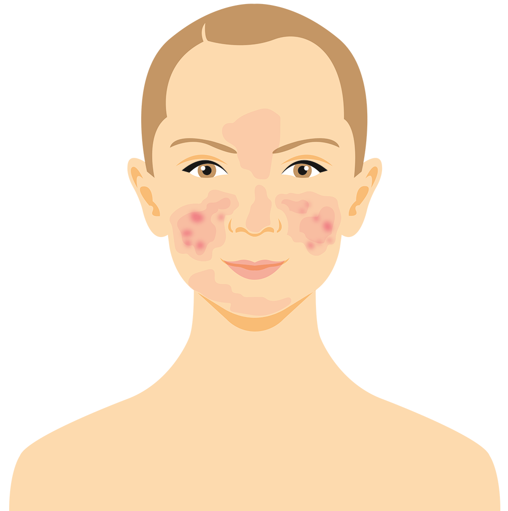 Sådan udvikler man hudsygdommen - fase 2