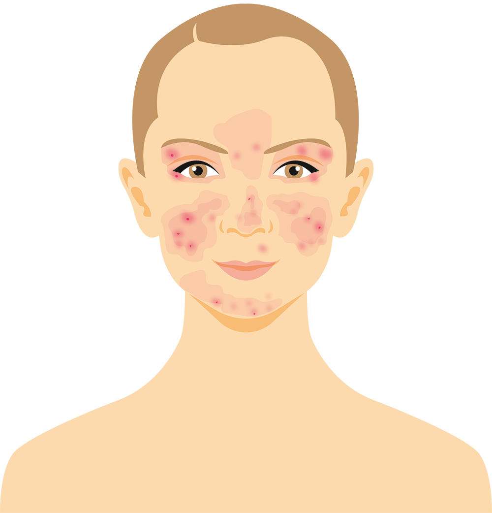 Sådan udvikler man hudsygdommen - fase 3