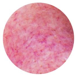 rosacea svær grad