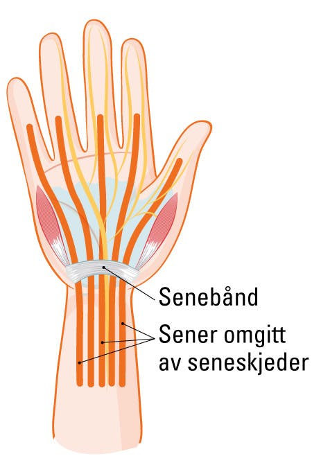 Sene- og seneskjedebetennelse i håndleddet