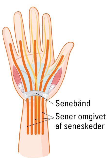 Du er særligt udsat for seneskedehindebetændelse i bl.a. håndledet, hvor seneskederne sidder tæt under senebåndet.