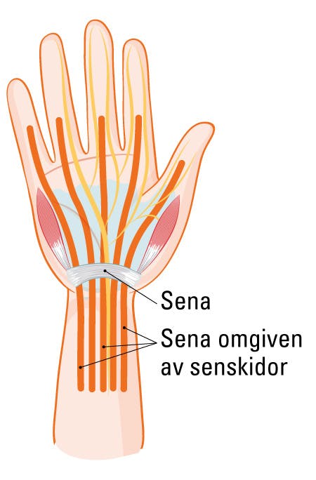 Senskideinflammation i handleden