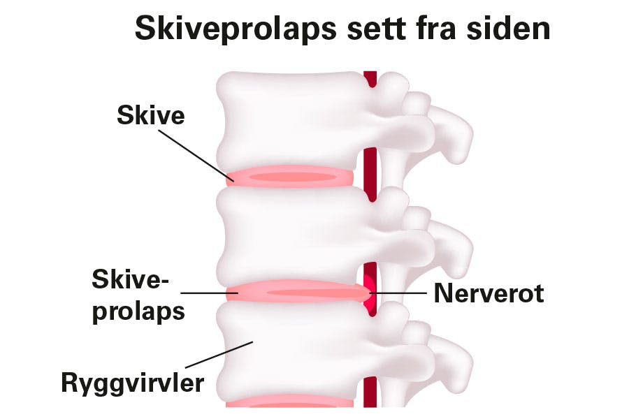Illustrasjon som viser en ryggsøyle med skiveprolaps.