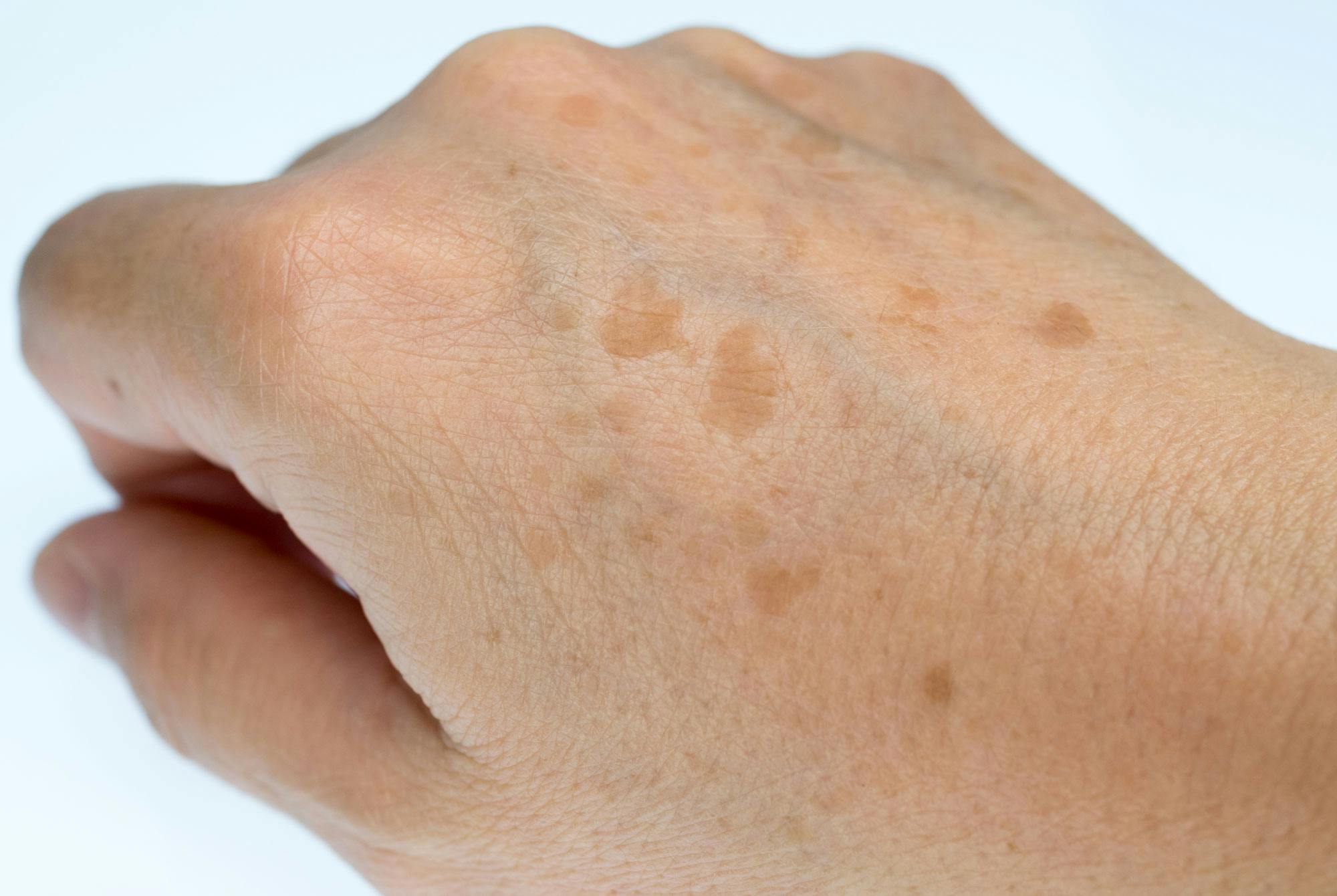 Solar lentigo: åldersfläckar på handryggen