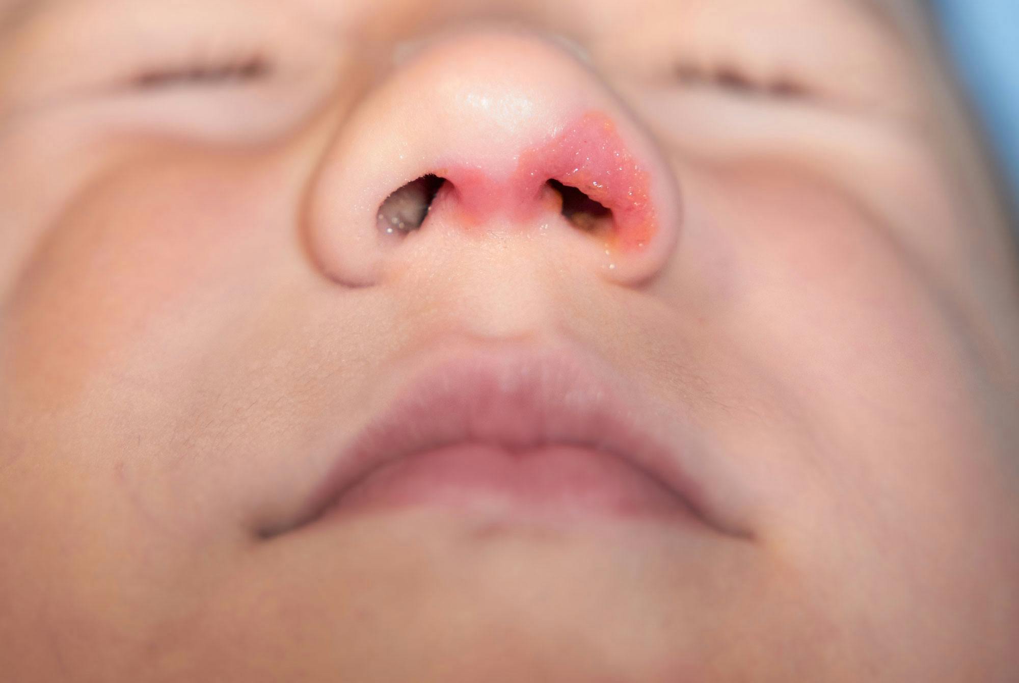 Bilder av stafylokokker i nesen symptomer - stafylokokker barn