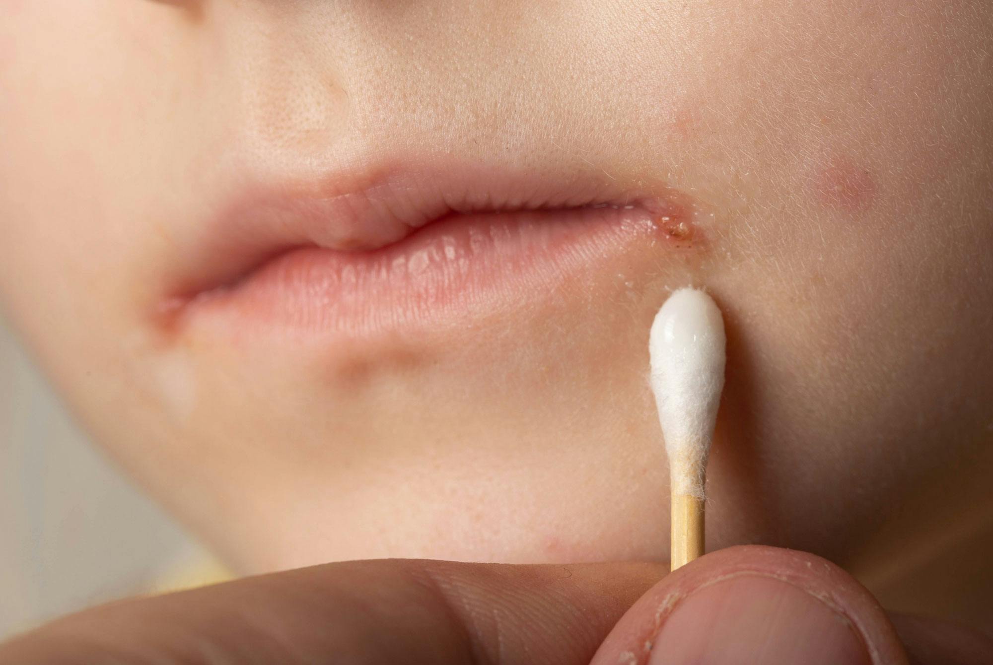 Stafylokokker i munnviken