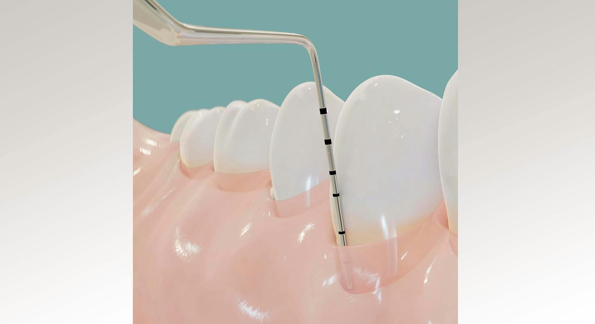 illustrasjon av en tannkjøttlomme som måles