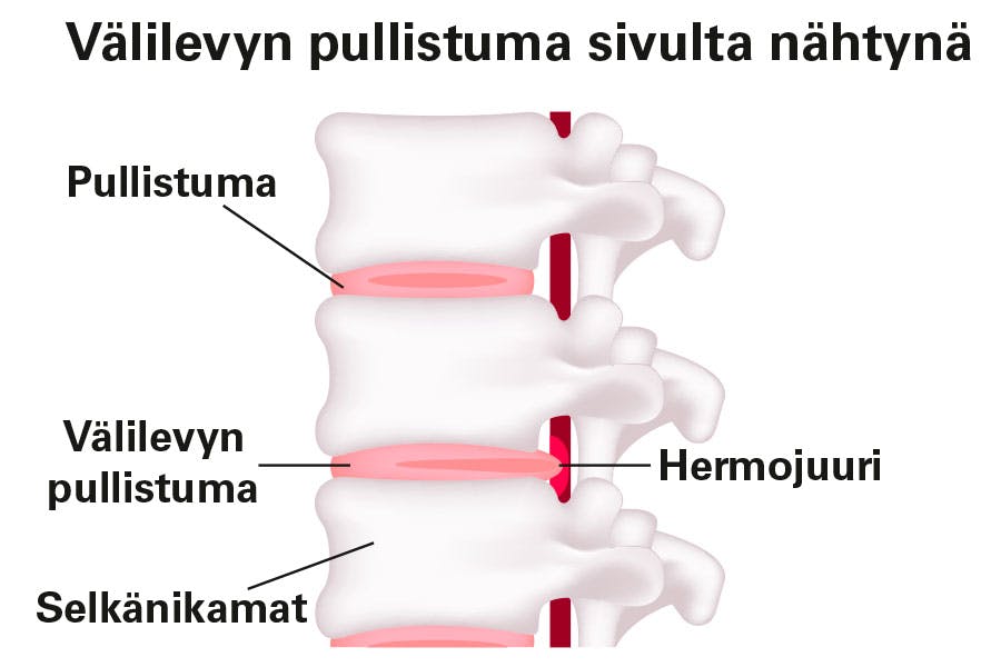 Kuva, jossa näkyy välilevyn pullistuma selkärangassa.