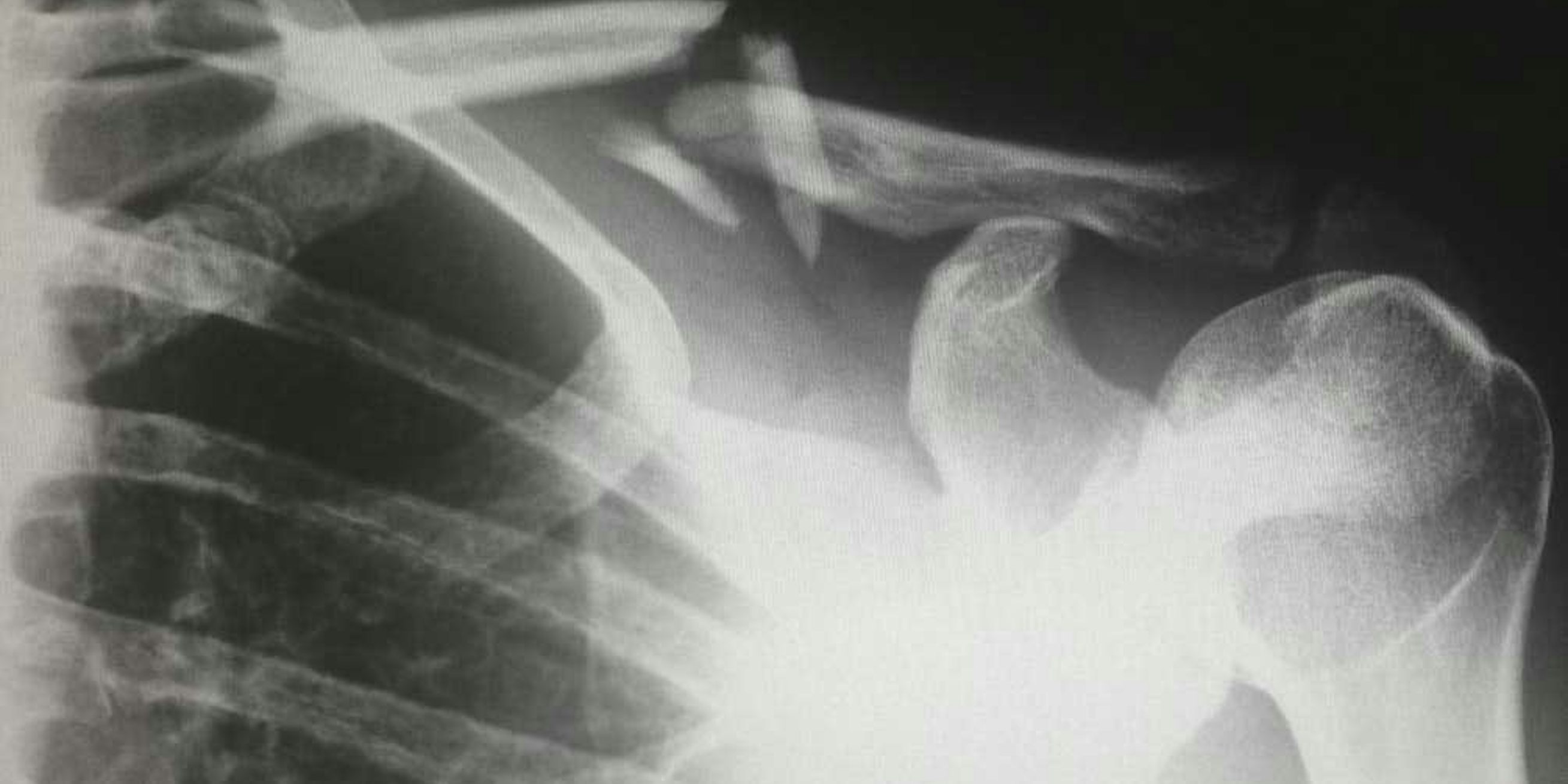 Bot: hoe geneest een botbreuk? | wibnet.nl