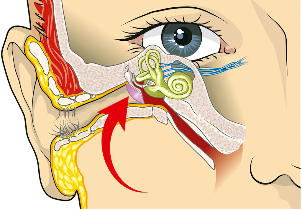 Oren Ploppen Niet Open Na Vliegen