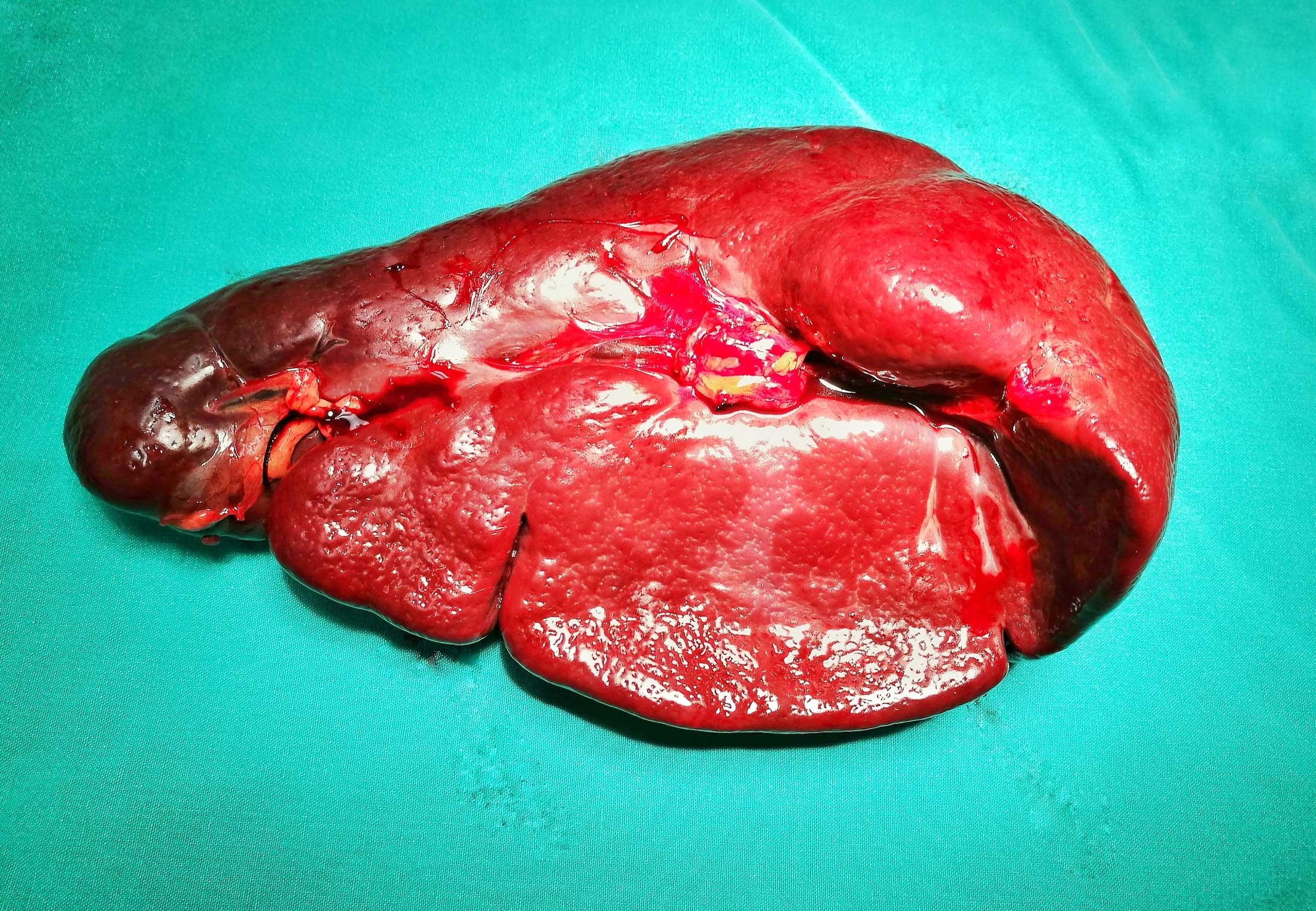 Wat is de functie van de milt en heb je hem wel nodig? | wibnet.nl