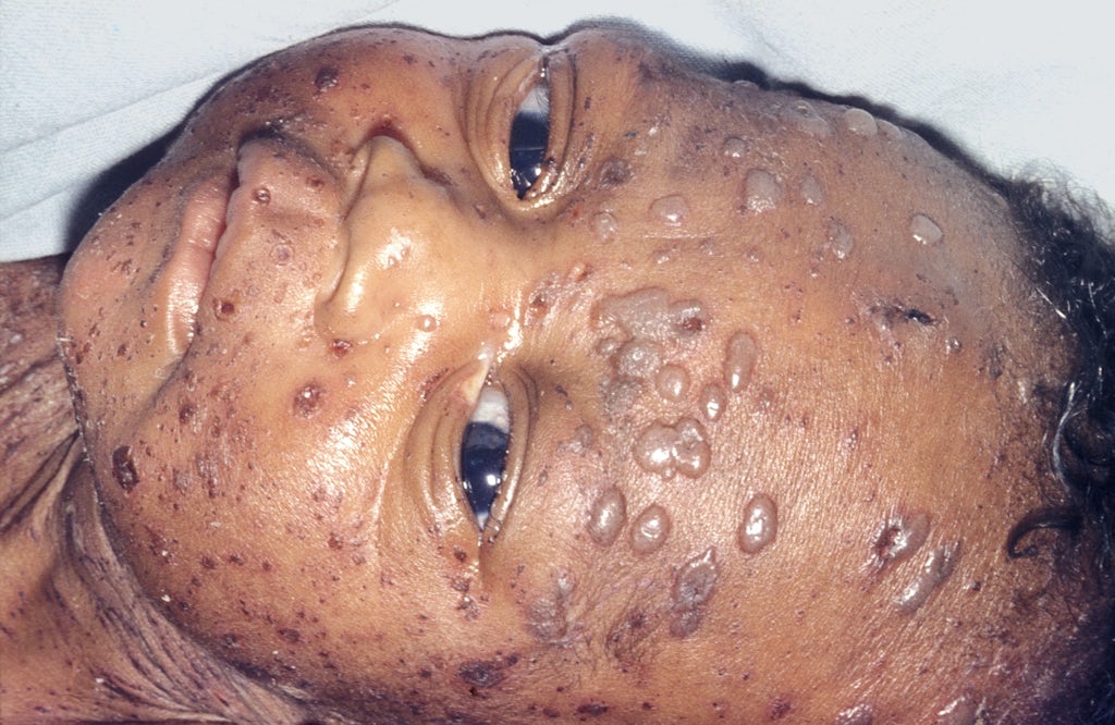 AIDS baby with herpes