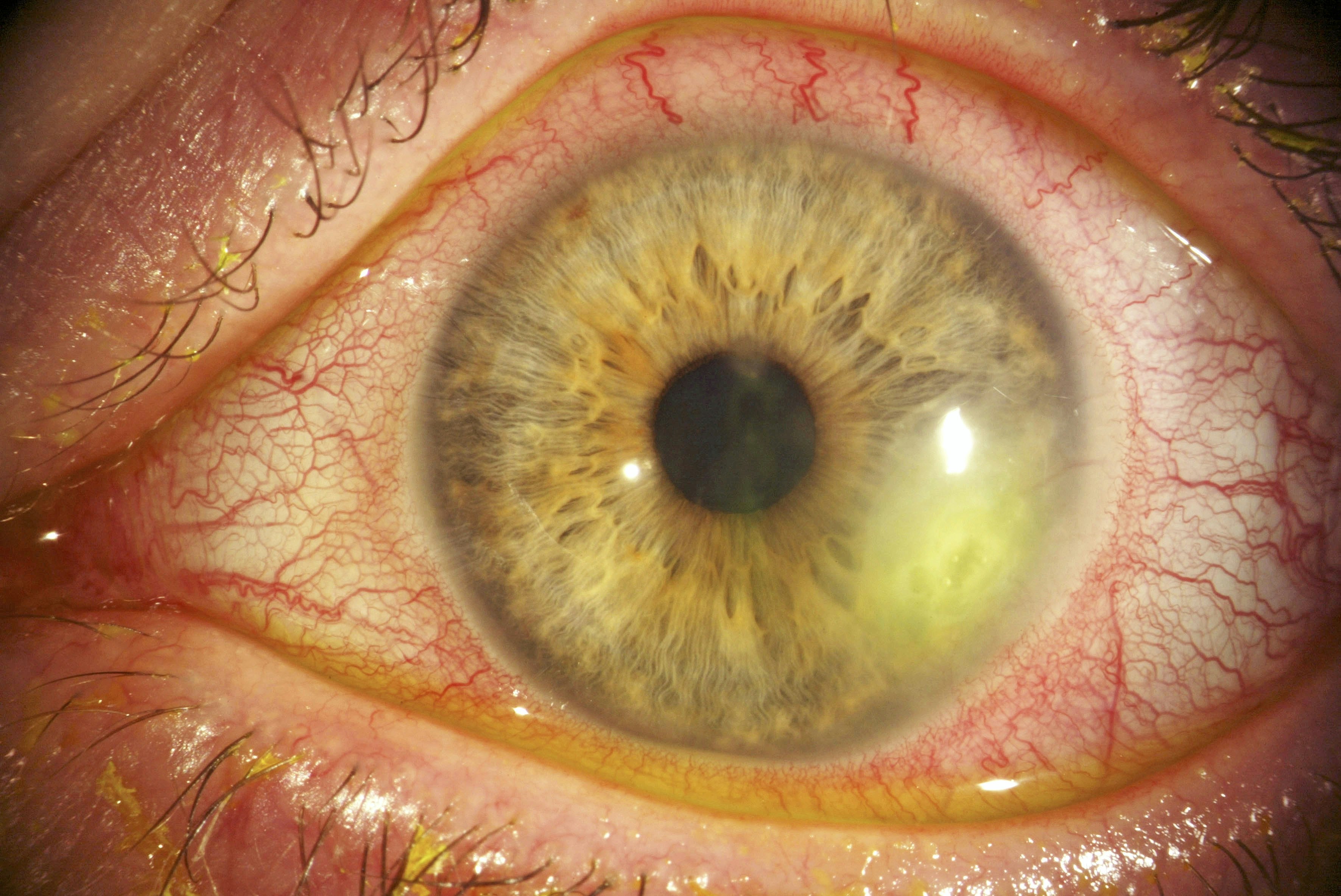 Herpes simplex keratitis