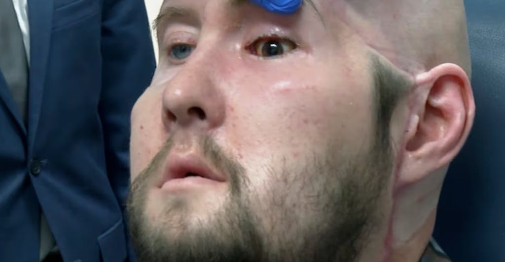 The world's first whole eye transplant shows promising progress after