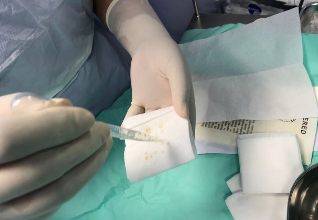 Levende maden ontdoen wonden van dood weefsel en bacteriën Levende maden ontdoen wonden van dood weefsel en bacteriën
