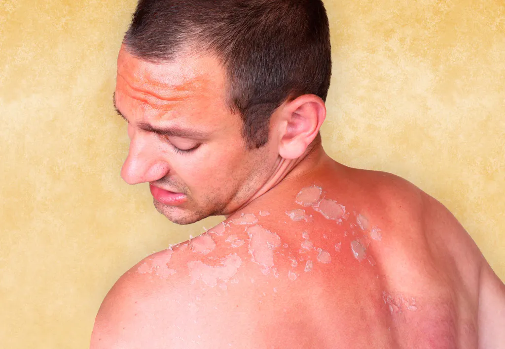 Verbranden In De Schaduw