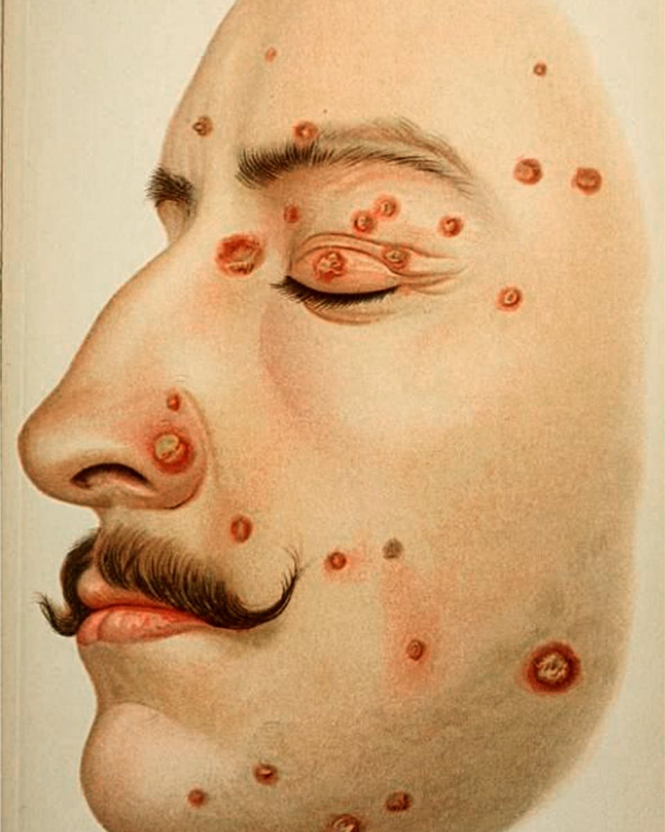 En bild av syfilis, ur en bok om könssjukdomar från 1898. En bild av syfilis, ur en bok om könssjukdomar från 1898.