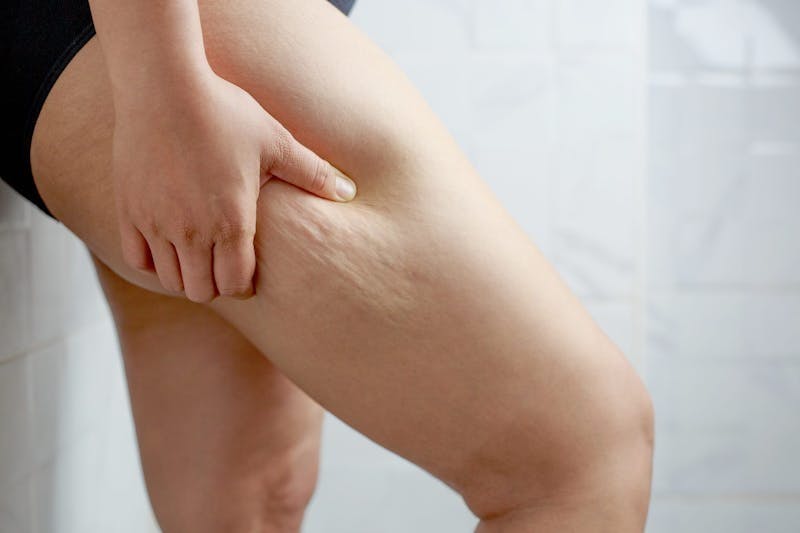 Celulitter og vannsamling