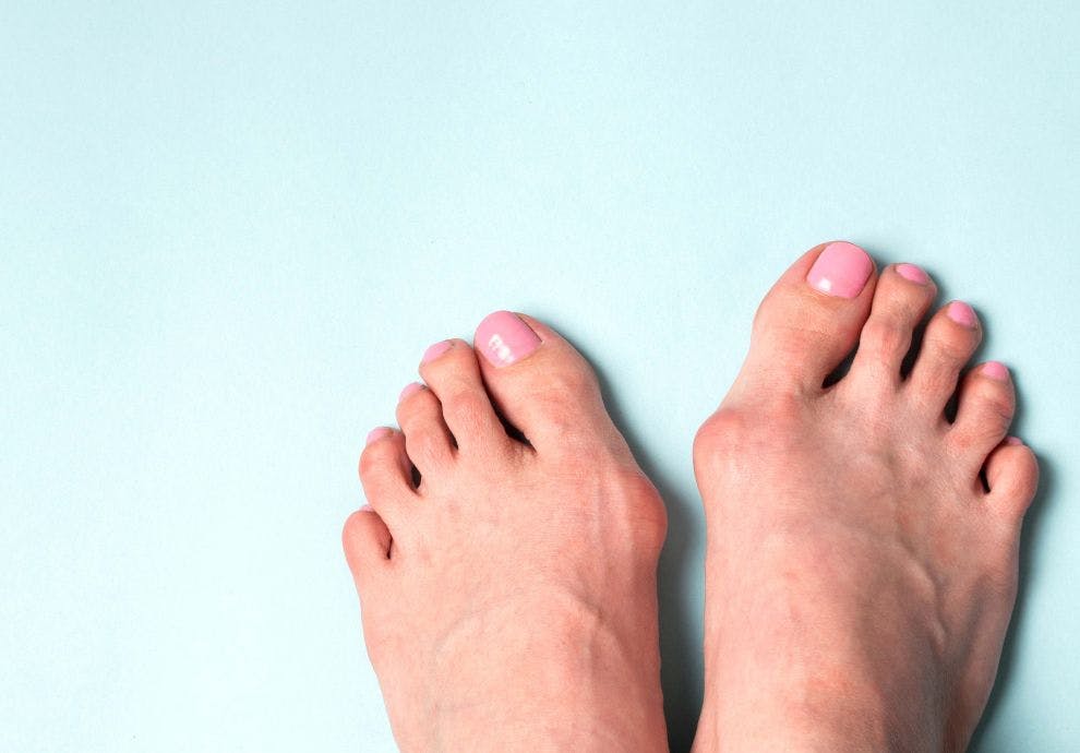 hallux valgus
