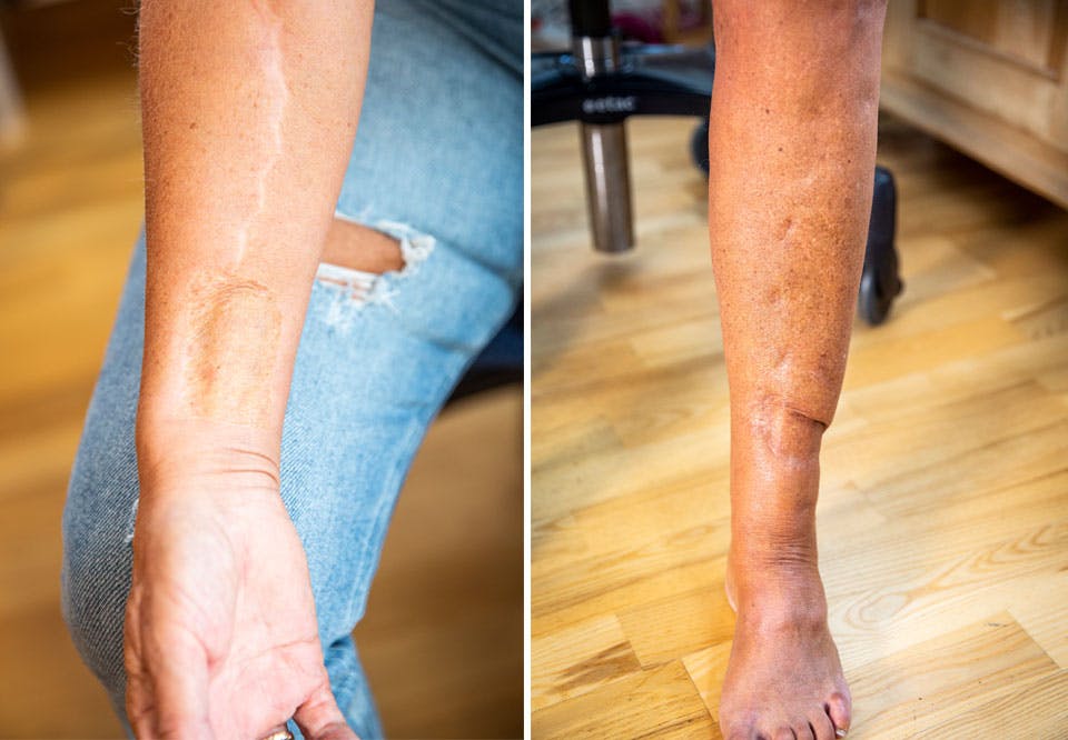 arm og fot HHsr 6NGfwUwD4JFl Rita Vindholmen, skader