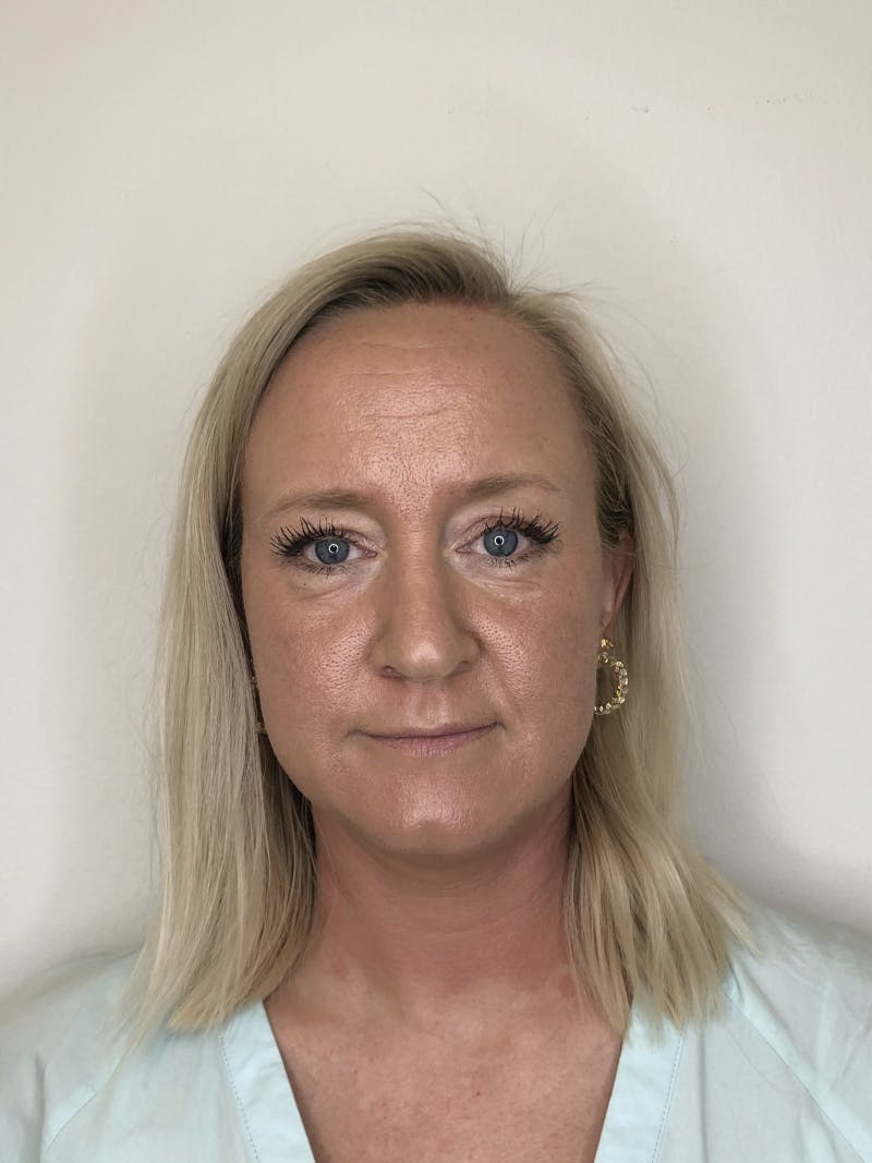 Behandling av ansikt med microneedling