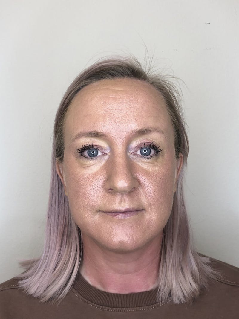 Etter behandling med microneedling og dermapen