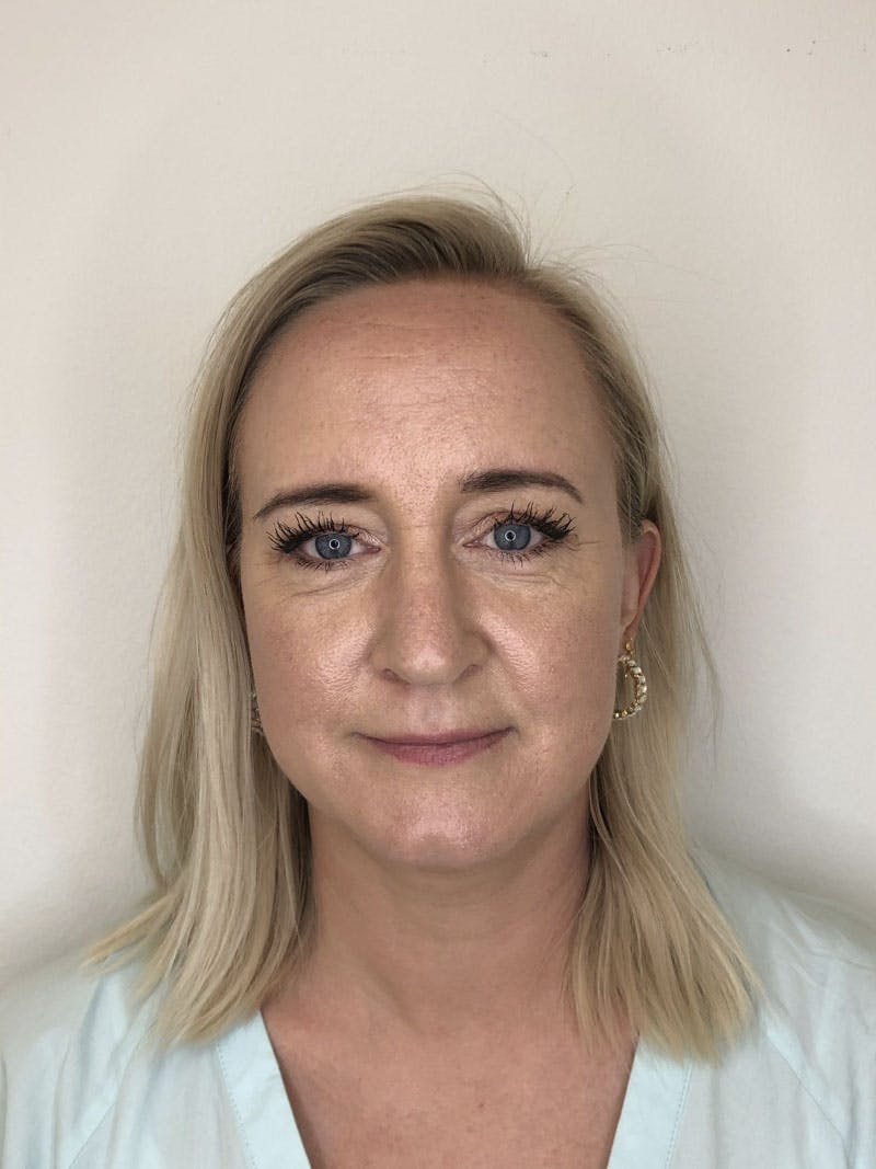 Microneedling test med dermapen