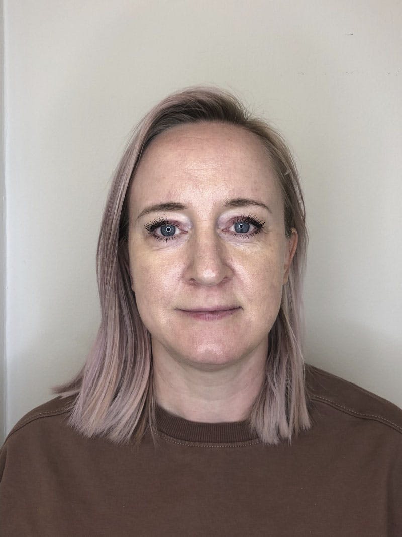 Micronnedling rødhet