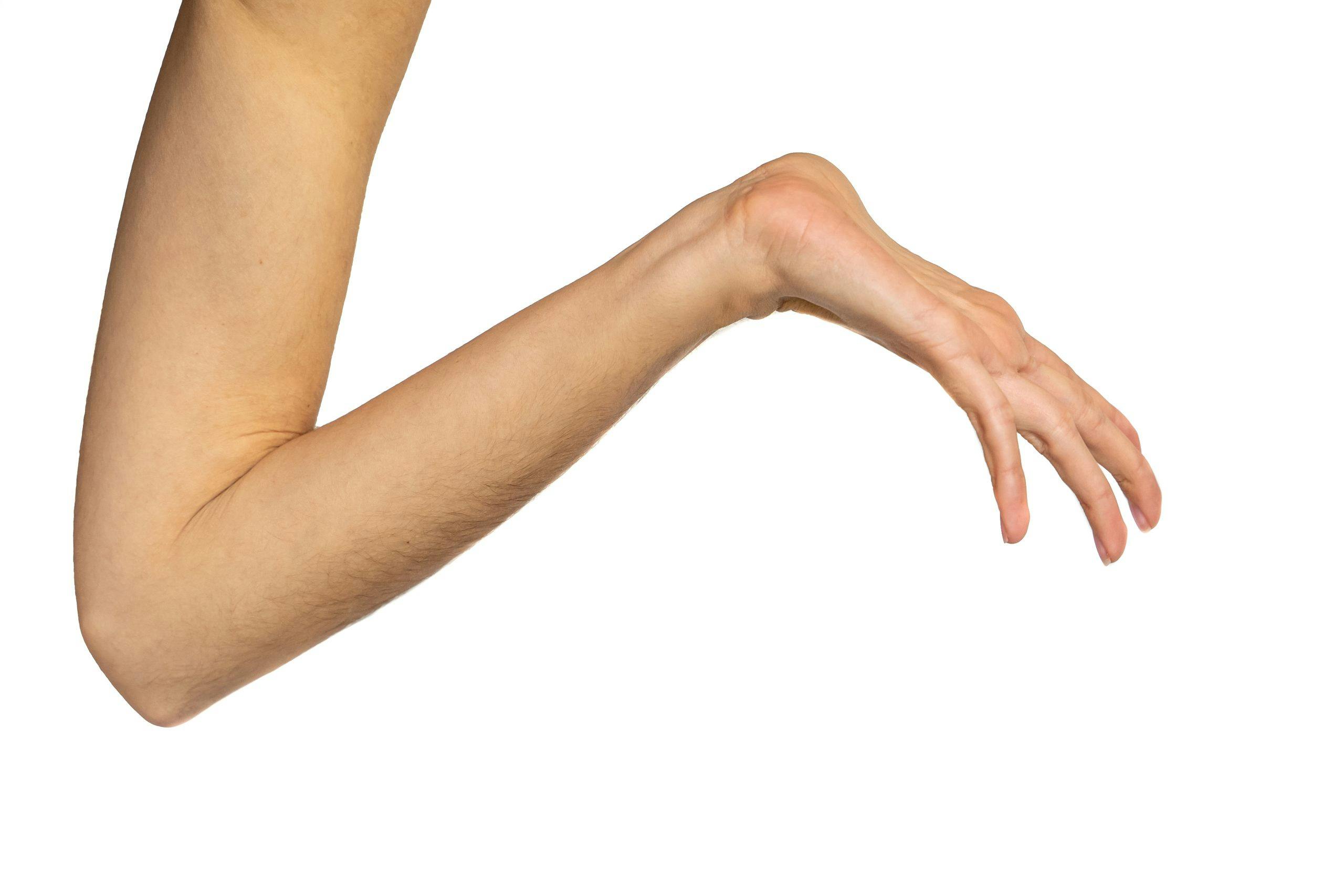 gettyimages 1273283745 1 Hypermobile ledd