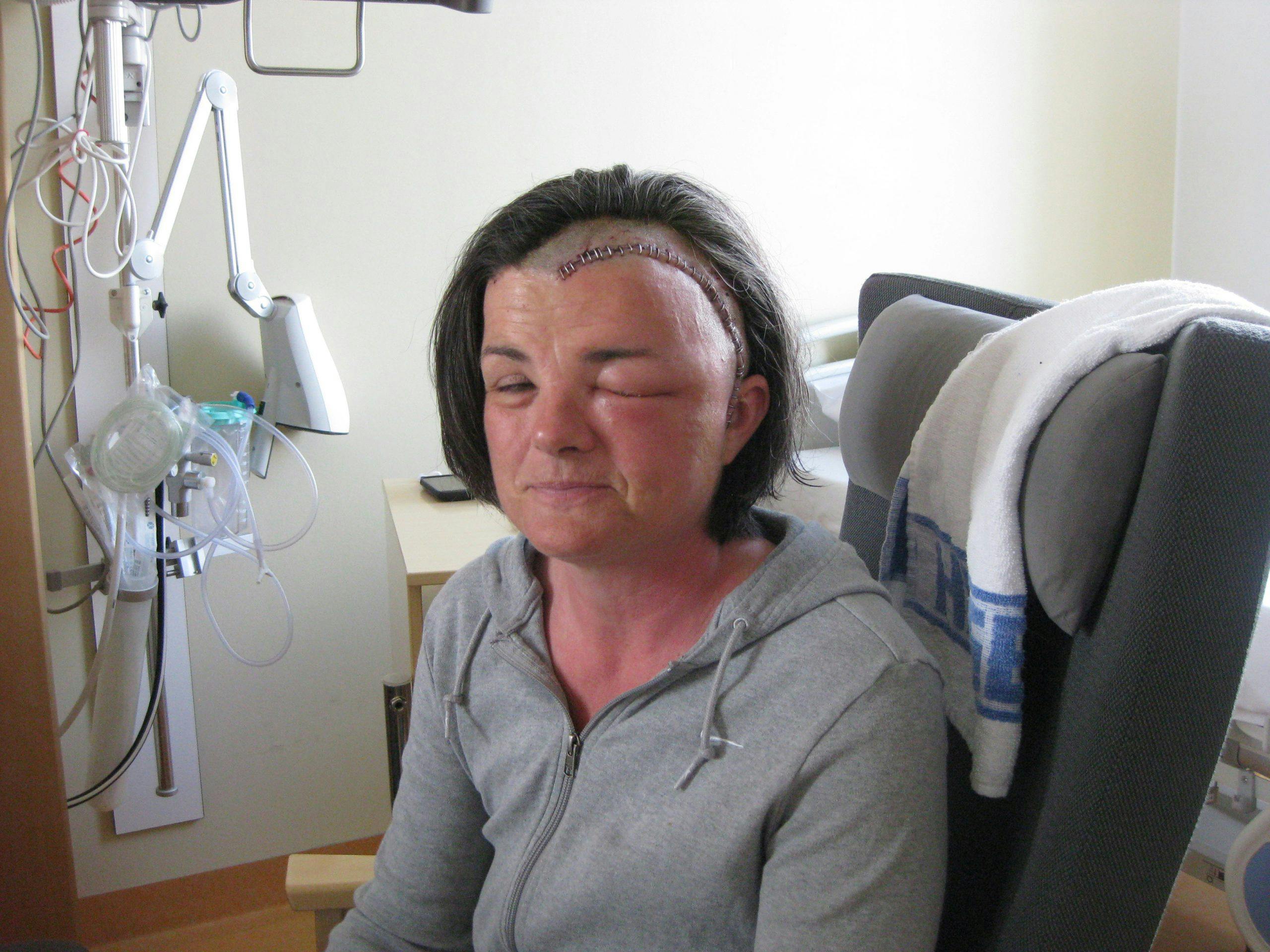 Etter operert hjernesvulst, med 35 sting i hodet.