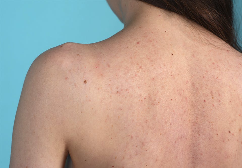 ryg, rynker, acne, kløe, knopper på ryggen