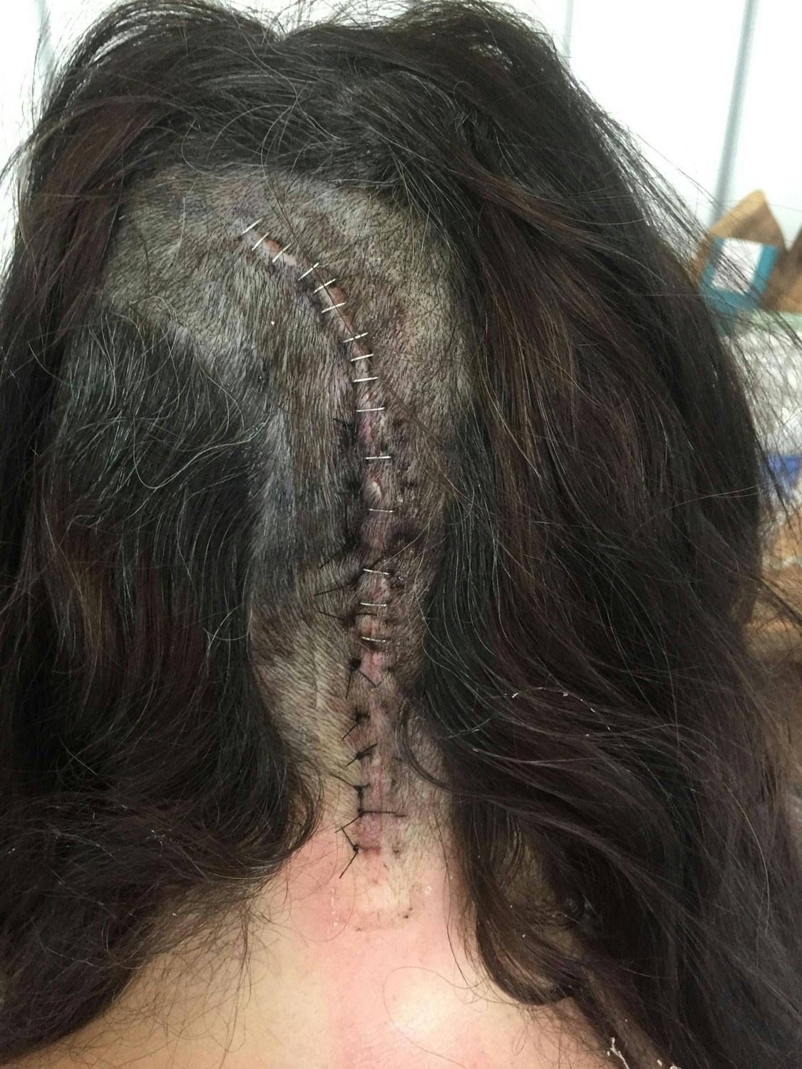 ARR: Marianne Antonsen artist hjernesvulst