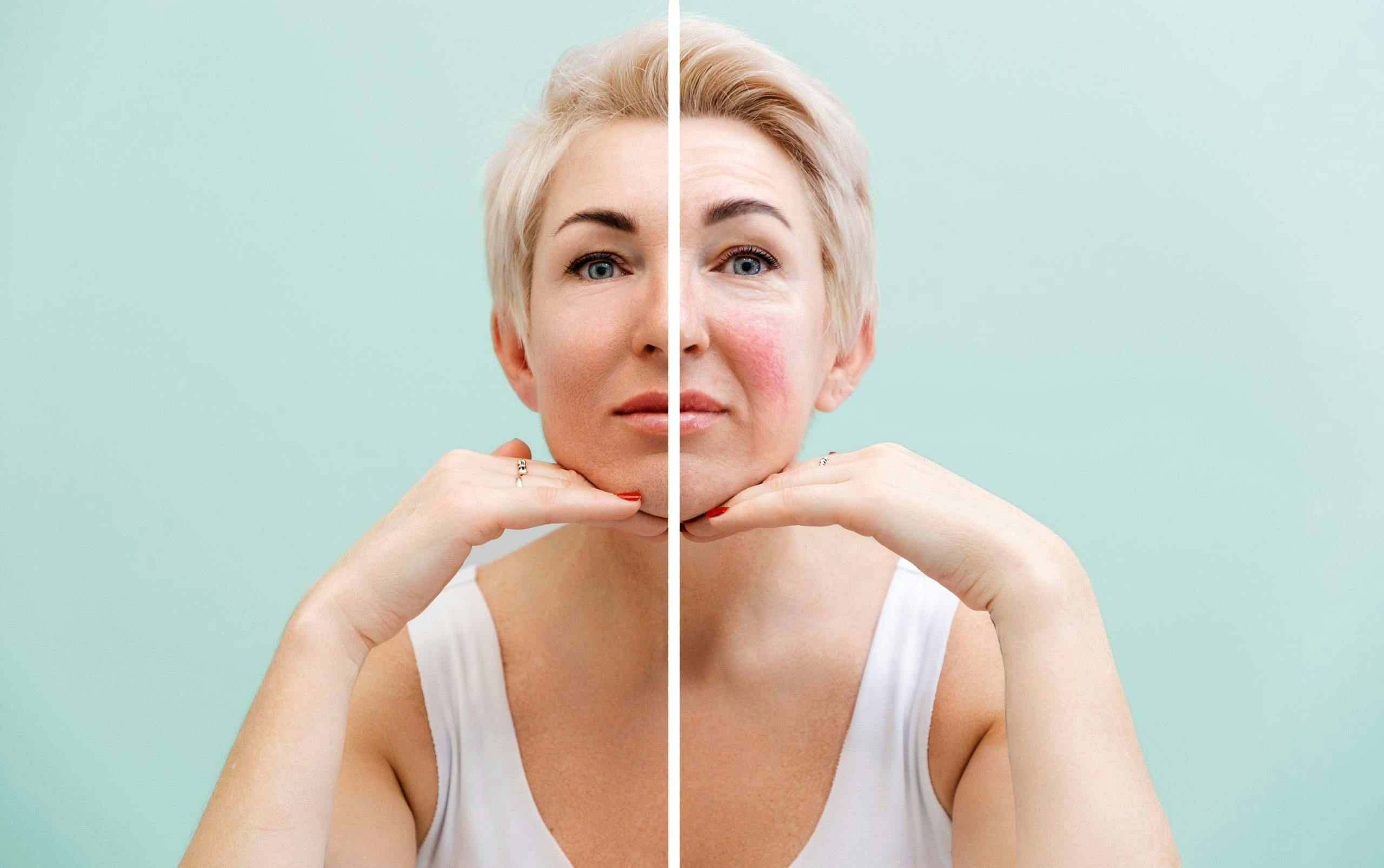 voksen hud og rosacea